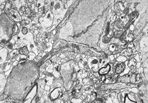 F,15y. | infantile neuroaxonal dystrophy (Seitelberger) F,15y. | infantile neuroaxonal dystrophy (Seitelberger)